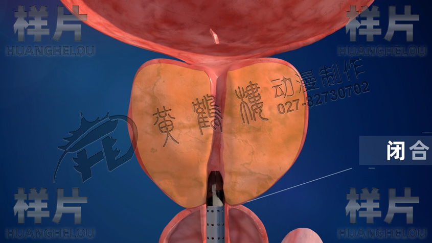 尿道保護(hù)鞘工作完閉合.jpg 尿道保護(hù)鞘工作完閉合.jpg