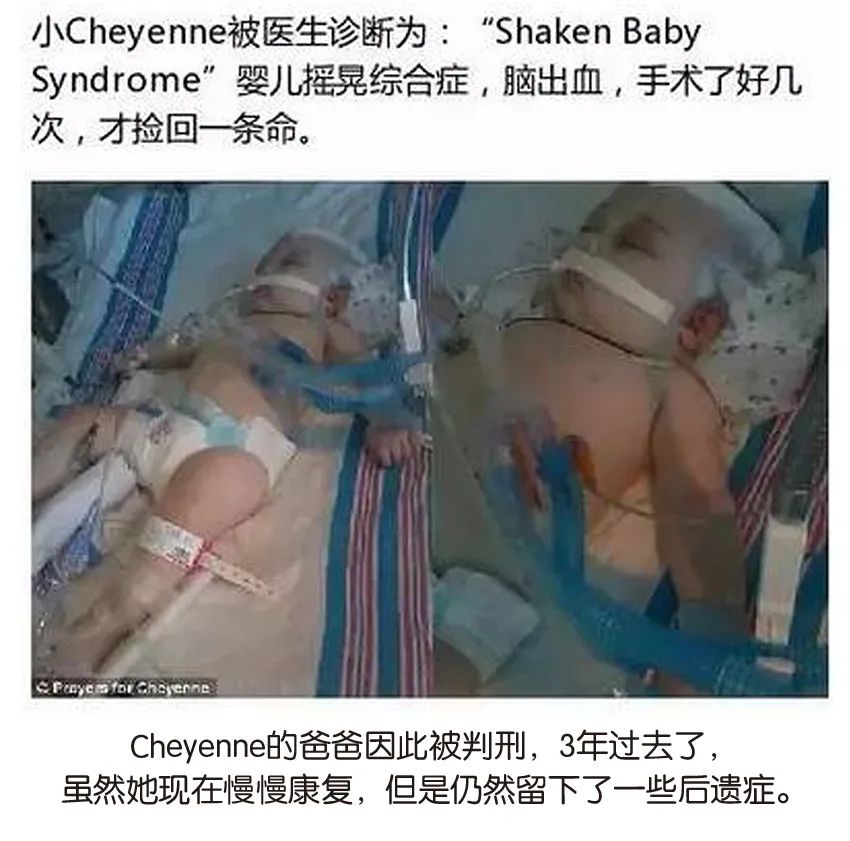 育兒醫(yī)學(xué)科普:大力搖晃會損傷寶寶的大腦致腦損傷